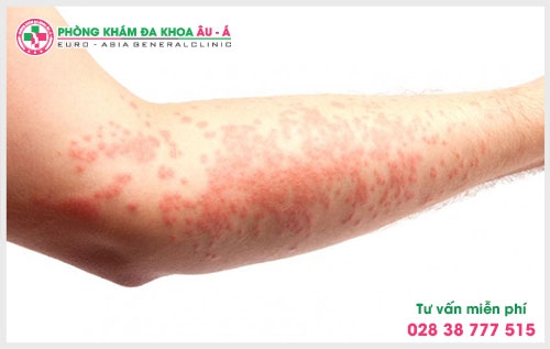 Bên cạnh điều trị bằng tây y thì có thể chữa bệnh bằng đông y, các loại thảo dược thiên nhiên này có tác dụng giảm ngứa bệnh chàm.