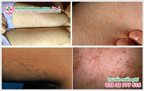 Bài biết dưới đây sẽ giúp ích cho bạn trong việc phát hiện để có cách chữa trị và chăm sóc vùng da bị dày sừng nang lông tốt hơn.