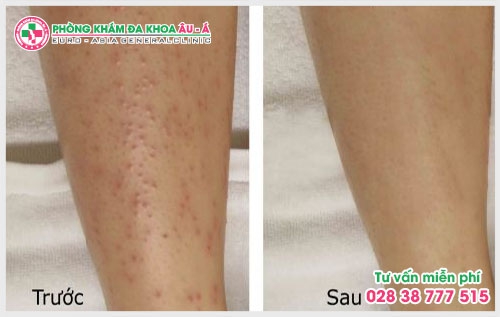 Bài biết dưới đây sẽ giúp ích cho bạn trong việc phát hiện để có cách chữa trị và chăm sóc vùng da bị dày sừng nang lông tốt hơn.