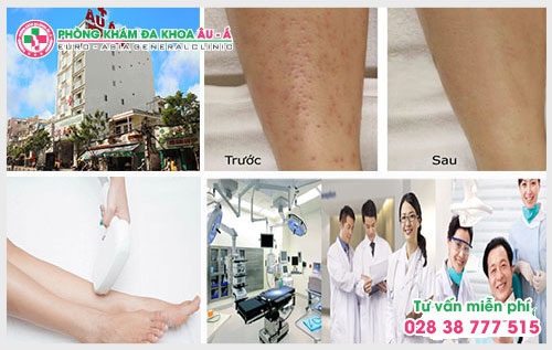 Bệnh dày sừng nang lông có chữa được không?