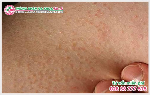 Bệnh dày sừng nang lông có chữa được không?