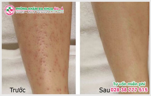 Bệnh dày sừng nang lông có chữa được không?