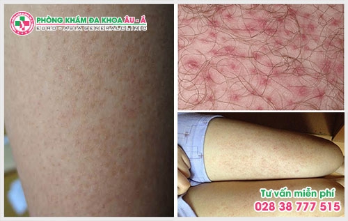 Bệnh dày sừng nang lông có chữa được không