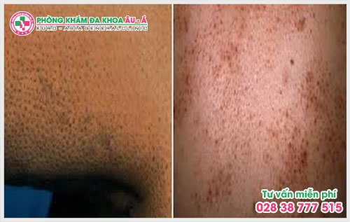 Bệnh dày sừng nang lông có chữa được không?