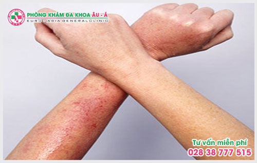 Bệnh dày sừng nang lông có chữa được không?