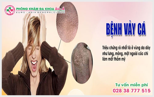 Bệnh vẩy da cá và cách điều trị hiệu quả