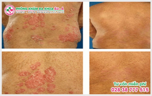 Bệnh vẩy da cá và cách điều trị hiệu quả