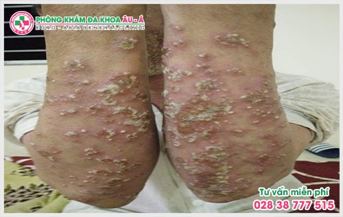 Chính vì thế bệnh vảy nến có lây không? Là điều thắc mắc của rất nhiều người và sẽ được các bác sĩ  tìm ra nguyên nhân và có hướng điều trị tốt hơn.