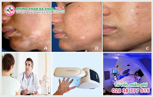 Cách chữa bệnh bạch biến mới 