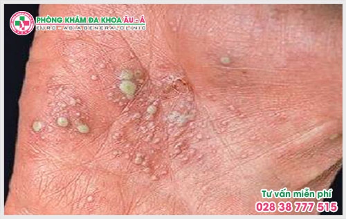 Vẩy nến có mủ chia lại hai loại vảy nến mụn mủ toàn thân và vảy nến mụn mủ lòng bàn tay bàn bàn chân.