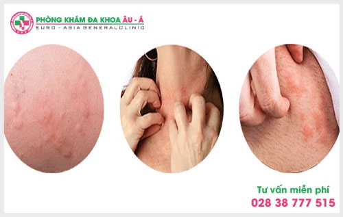 Theo các chuyên gia để chữa trị bệnh ngứa trong máu thì cần xác định được chính xác nguyên nhân từ đó mới có thể đưa ra phương pháp điều trị phù hợp