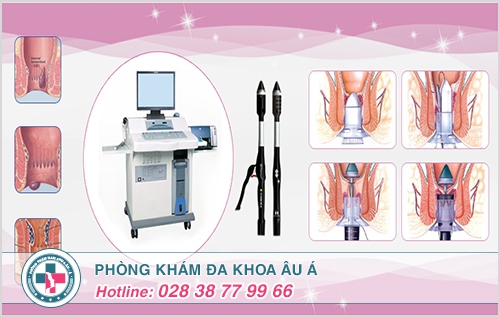 Chi phí cắt trĩ nội bằng laser tại TPHCM