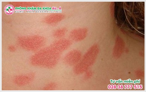 Nhiều người bệnh vẫn chưa đi khám vì còn lo lắng về chi phí xét nghiệm vảy nến hết bao nhiêu? Đây chính là điều mà rất nhiều người bệnh quan tâm.