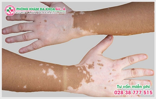 Dấu hiệu triệu chứng của bệnh bạch biến