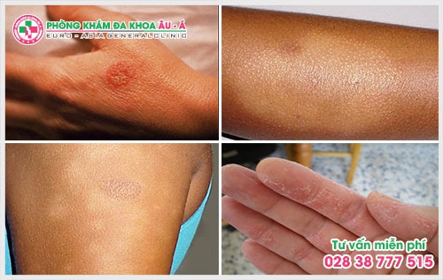 khi có các triệu chứng bệnh bệnh chàm người bệnh nên nhờ sự giúp đỡ của các bác sĩ da liễu để tránh những hậu quả nghiêm trọng về sau