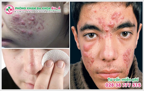 Chính vì thế mà việc tìm một địa chỉ chữa bệnh mụn trứng cá ở TPHCM là điều mà nhiều chị em, phụ nữ quan tâm hiện nay.