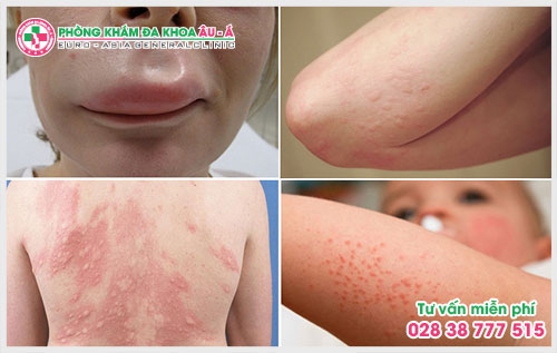 Chính vì thế, để có thể khám bệnh ngứa ở đâu tốt  tại TPHCM? Là điều mà rất nhiều người đang quan tâm.