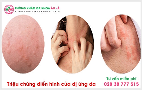 　　Để giúp người bệnh có thể lựa chọn đúng đắn trong việc khám dị ứng ở đâu tốt  tại TPHCM? Thì phòng khám đó phải đạt được những yêu cầu như: