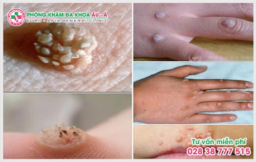 Chính vì thế bài viết hôm nay sẽ giúp bạn có thể lựa chọn địa chỉ khám hạt cơm ở đâu tốt  TPHCM và những điều mà bạn chưa biết về hạt cơm.