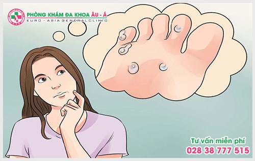 Không nên chủ quan khi bị mụn cóc ở chân