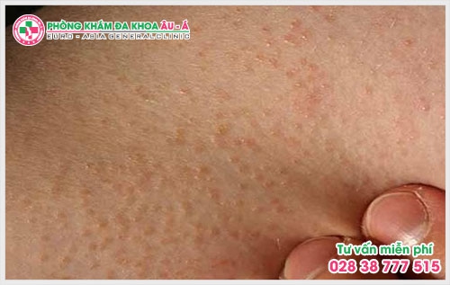 Vì thế, kinh nghiệm chữa dày sừng nang lông dưới đây sẽ giúp ích cho bạn trong việc ngăn ngừa cũng như có cách chữa bệnh dày sừng nang lông tốt .