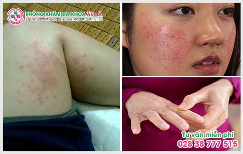 Có rất nhiều cách để điều trị bệnh mẩn ngứa, tùy theo từng nguyên nhân gây bệnh mà các chuyên gia da liễu sẽ sử dụng những phương pháp phù hợp