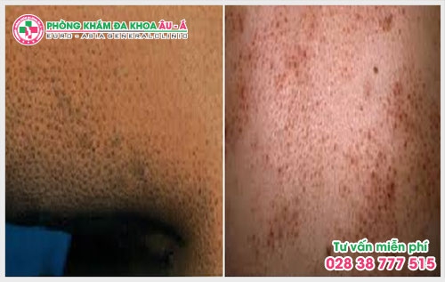 Một số mẹo chữa bệnh dày sừng nang lông dưới đây sẽ giúp ích cho bạn trong việc ngăn chặn, phòng tránh bệnh một cách hiệu quả và an toàn.