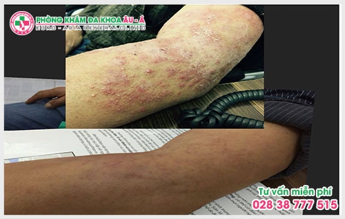 Một số mẹo chữa bệnh dày sừng nang lông dưới đây sẽ giúp ích cho bạn trong việc ngăn chặn, phòng tránh bệnh một cách hiệu quả và an toàn.