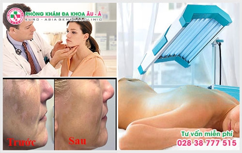 Nguyên nhân và cách điều trị bệnh bạch biến