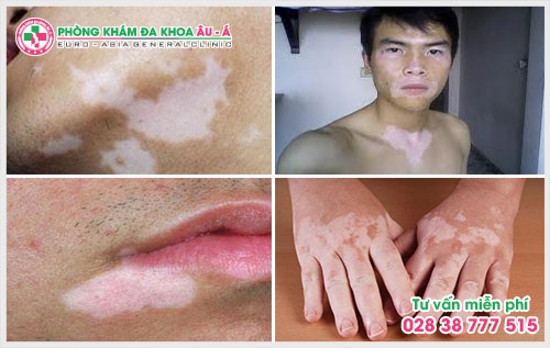 Nguyên nhân và cách điều trị bệnh bạch biến