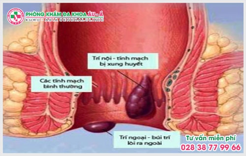 Viêm hậu môn nếu như không phát hiện kịp thời có thể dẫn đến nhiều biến chứng nguy hiểm cho sức khỏe. Vậy nguyên nhân viêm hậu môn trực tràng là gì?