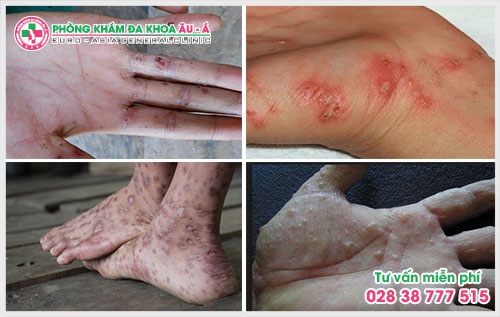 Cách trị bệnh ghẻ lở hắc lào không khó nếu như phát hiện sớm và có sự can thiệp của bác sĩ chuyên môn nghiệp vụ.