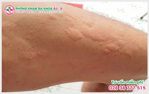 Thời tiết chuyển đột ngột từ nóng sang lạnh khiến cơ thể thích ứng không kịp cũng là một nguyên nhân gây ra bệnh mẩn ngứa nổi mề đay.