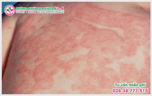 Tính chất công việc phải làm việc trong môi trường nhiễm bẩn, tiếp xúc với các hóa chất là một trong những nguyên nhân gây ra bệnh nấm da chàm hóa.