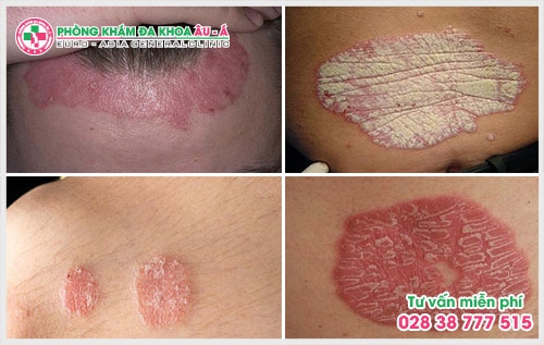 Chính vì thế mà việc tìm một phòng khám bệnh viêm da TPHCM ngoài giờ là điều mà được rất nhiều người bệnh quan tâm.