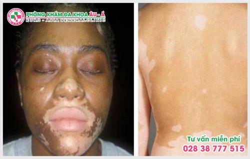 Phòng khám dịch vụ bệnh bạch biến tại TPHCM