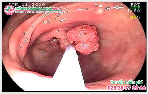 Khi bị polyp hậu môn trực tràng nên làm gì? Đây chính là câu hỏi thắc mắc của rất nhiều người bệnh trong số đó có bạn Nhật Huy đã gởi tâm sự của mình về chuyên mục tư vấn bệnh hậu môn trực tràng tại phòng khám Đa Khoa Âu Á. 