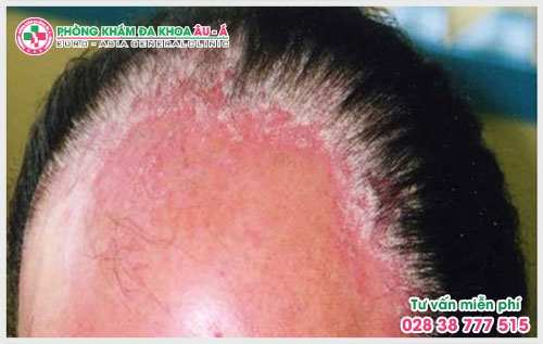 Bệnh á sừng, vẩy nến là một dạng viêm da có thể xuất hiện ở nhiều vị trí khác nhau trên cơ thể, bệnh vảy nến á sừng ở tay, ở đầu, chân.