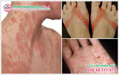 Những triệu chứng bệnh về bệnh chàm có thể điều trị được nếu như phát hiện kịp thời và có sự can thiệp của các bác sĩ chuyên khoa