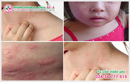 Thông qua chuyên mục tư vấn bệnh bệnh ngứa, các bác sĩ Da Liễu Âu Á có những giải đáp cụ thể sau