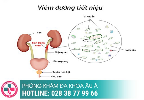 Viêm đường tiết niệu ở nam và dấu hiệu nhận biết?