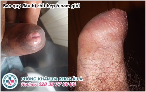 bao quy đầu không tự tuột