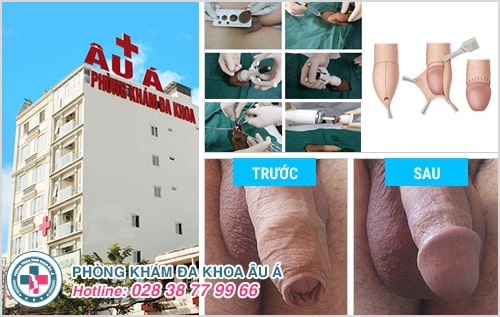bao quy đầu không tự tuột
