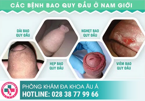 Nguyên nhân khiến dương vật bị thâm đen là do đâu?