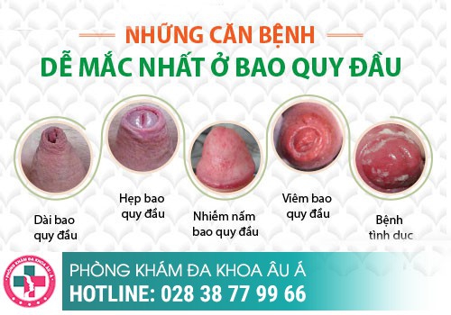 Bao quy đầu bị sưng phồng lên như cục mỡ là bị bệnh gì?