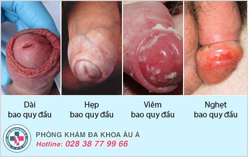 Bệnh sinh dục là gì? Có nguy hiểm không?