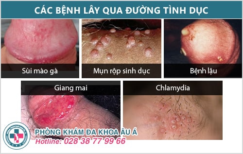 Bệnh sinh dục là gì? Có nguy hiểm không?