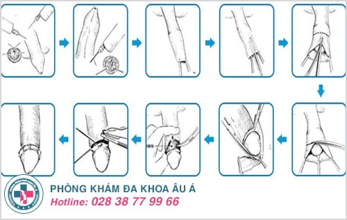 cách khắc phục xuất tinh sớm