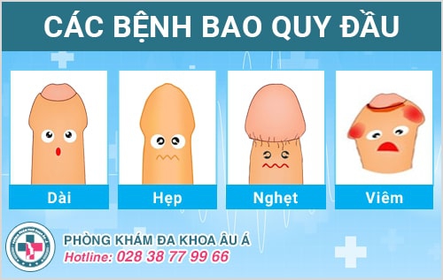 cắt bao quy đầu