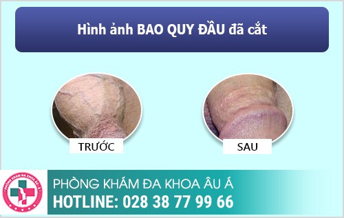 Cắt bao quy đầu 